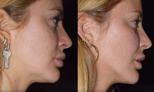 cheek enhancement before after mississauga oakville